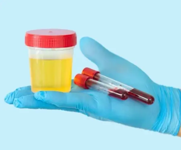 Urine Specimen Collection